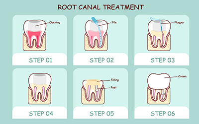 Cartoon tooth root canal treatment plan